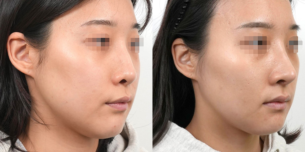 코재수술(자가늑+핏미)