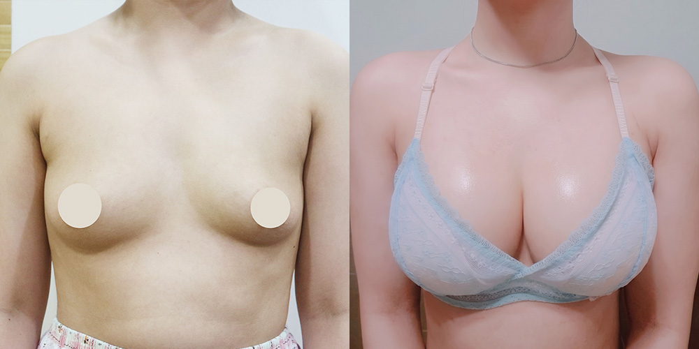 가슴확대(멘토라운드)