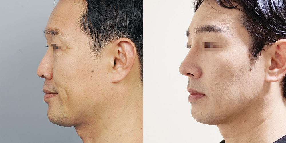 코성형(기증늑)