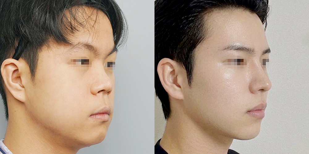 코재수술(자가늑+노플란트)