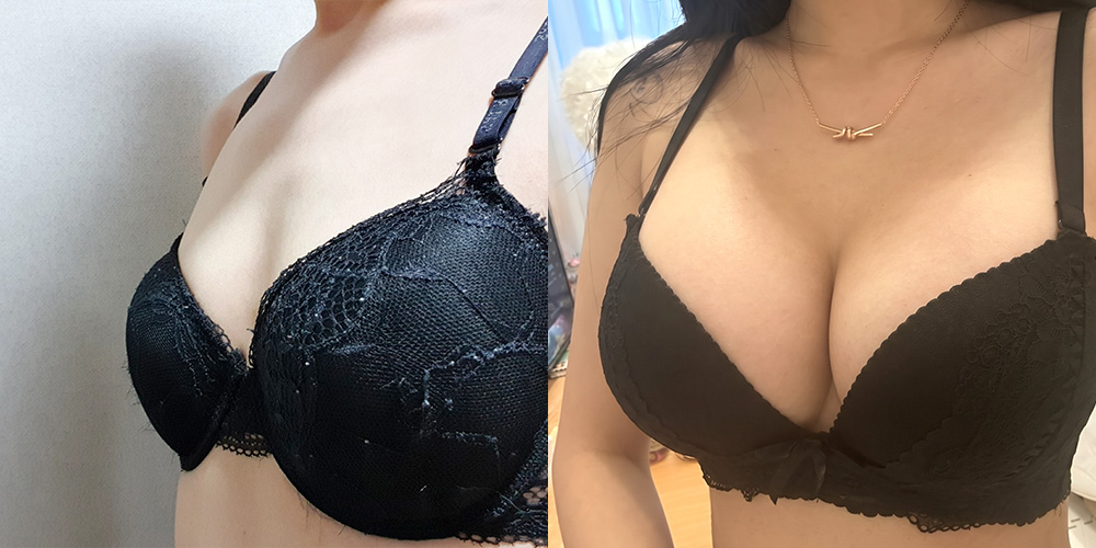 가슴확대(멘토클래식)
