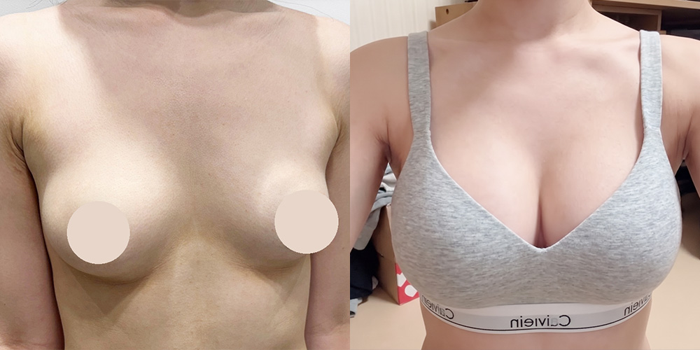 가슴확대(세빈)