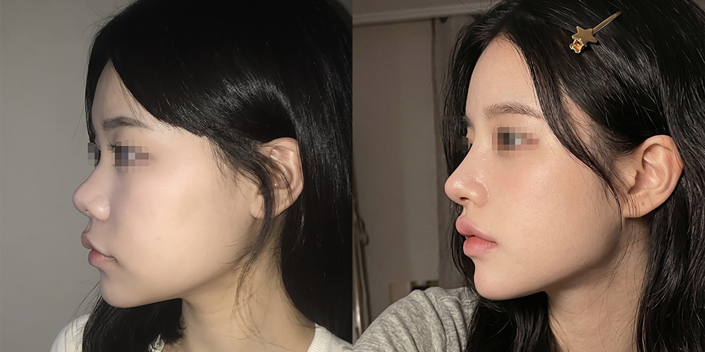 코성형(복코교정)