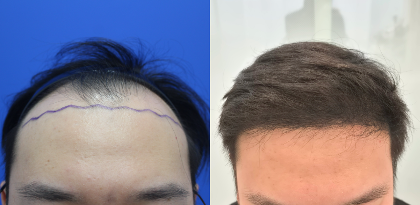 남성모발이식 헤어라인 절개 4500모