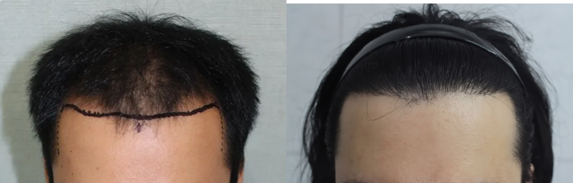 남성모발이식(헤어라인 절개 3800모)