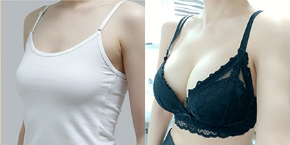 가슴확대(세빈) 340cc