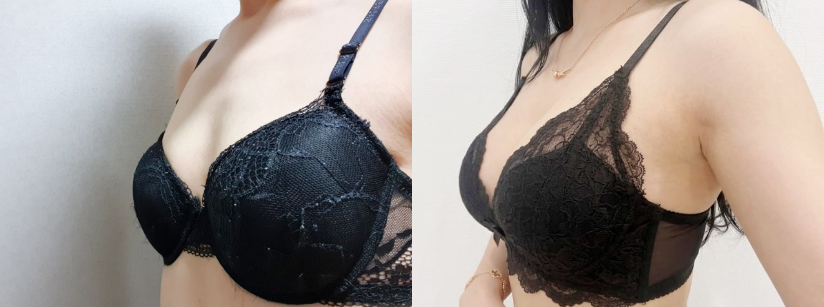 가슴확대(멘토 클래식 텍스쳐)