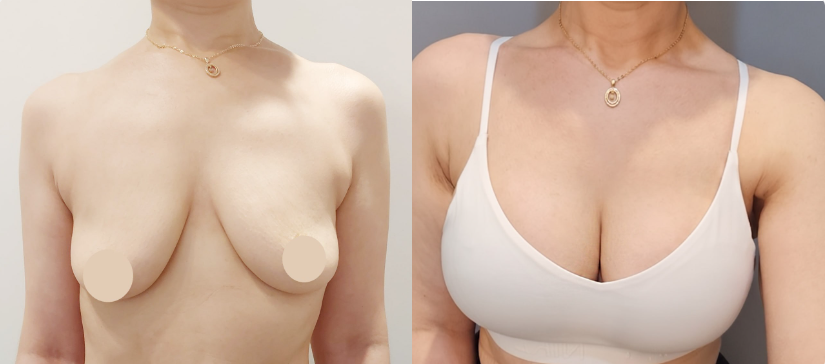 가슴확대(멘토엑스트라 355cc)+부유방