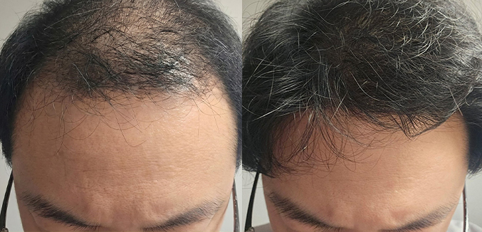 남성모발이식(헤어라인,정수리 혼용 절개5000모 비절개 1000모)
