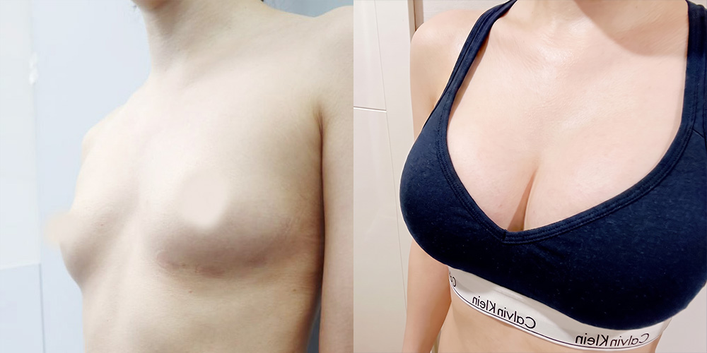가슴확대(세빈)