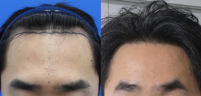 남성모발이식(헤어라인 절개 2000-2500모)