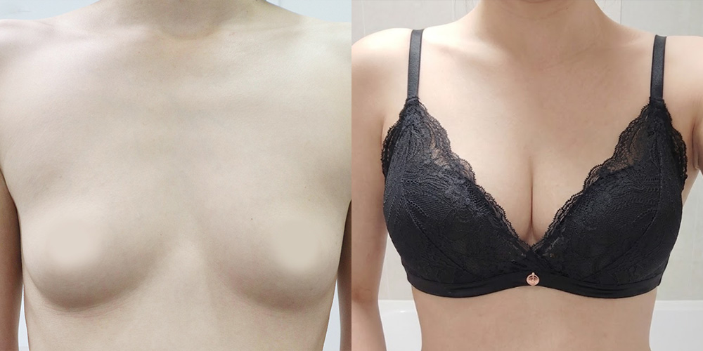 가슴확대(세빈)