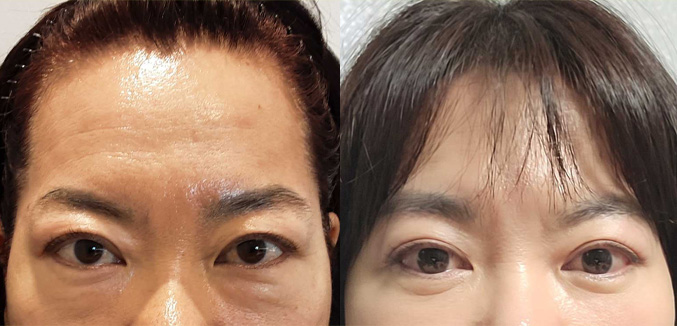 눈썹하거상+하안검