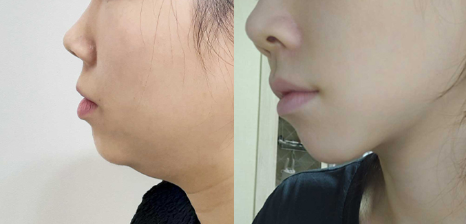 이중턱흡입+근육묶기