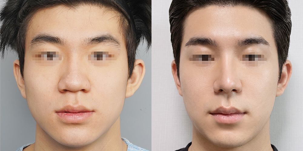 코성형(콧날개줄임+기증늑+복코교정+비중격)