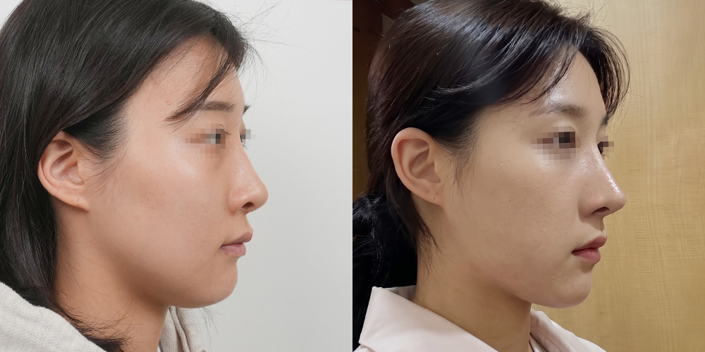 코재수술(자가늑+핏미)