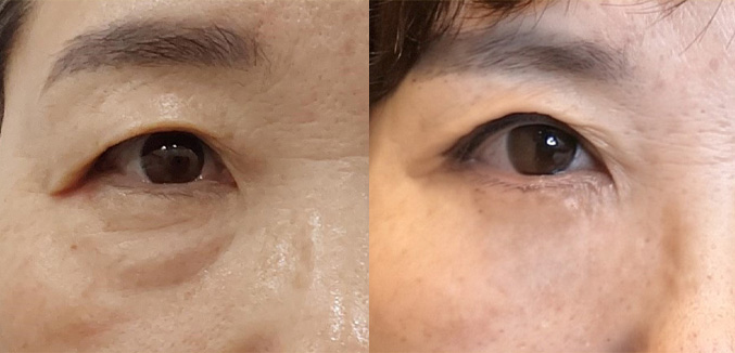 눈(상안검눈매교정+하안검)