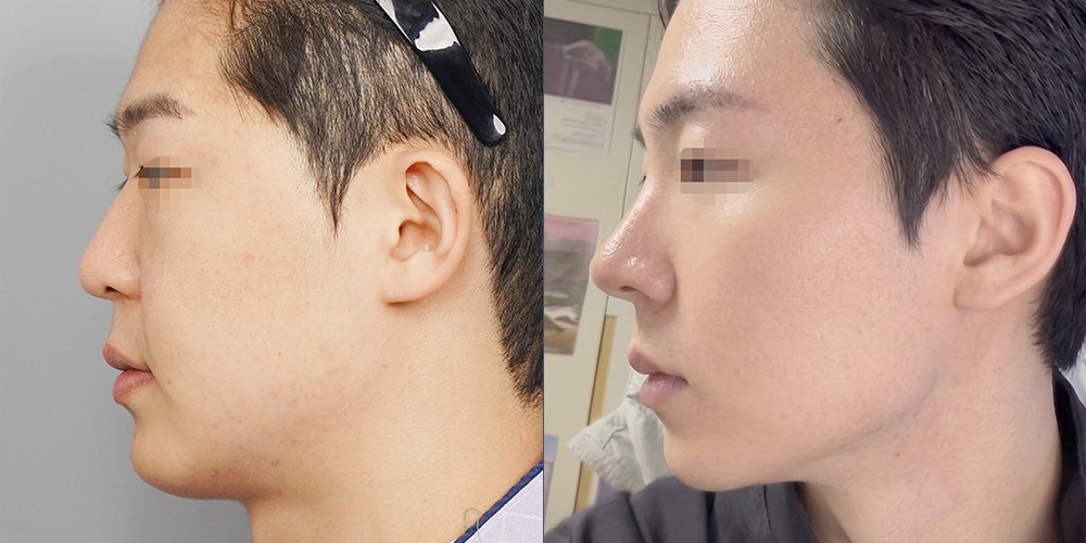 코성형(자가늑)