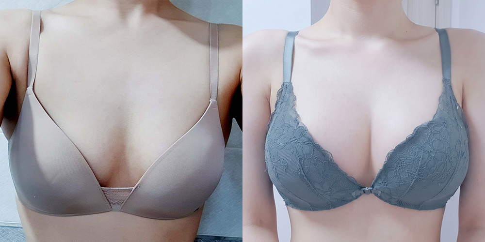가슴확대(멘토엑스트라)