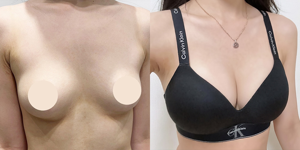 가슴확대(모티바)
