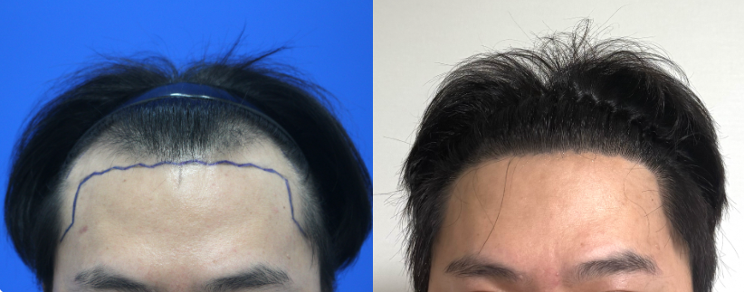 남성모발이식(헤어라인+전두부 혼용 절개3000모+비절개2000모)