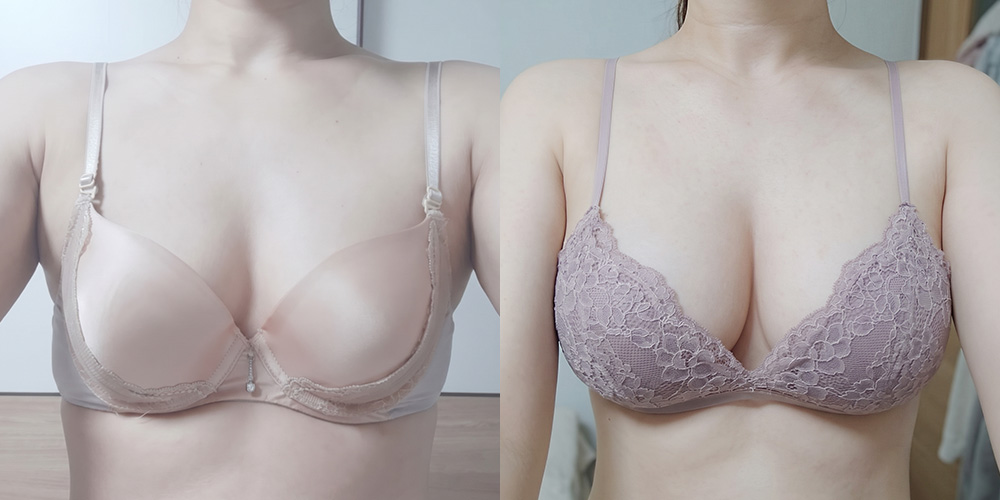 가슴확대(모티바)