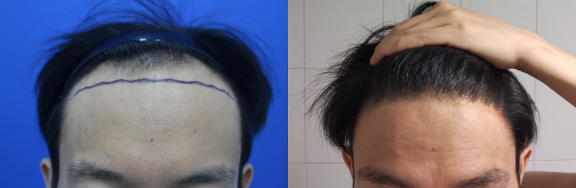 남성모발이식(헤어라인 비절개 3500모)