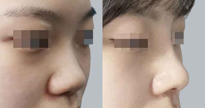 개방코성형