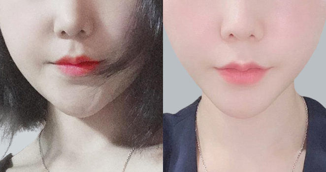 리프팅