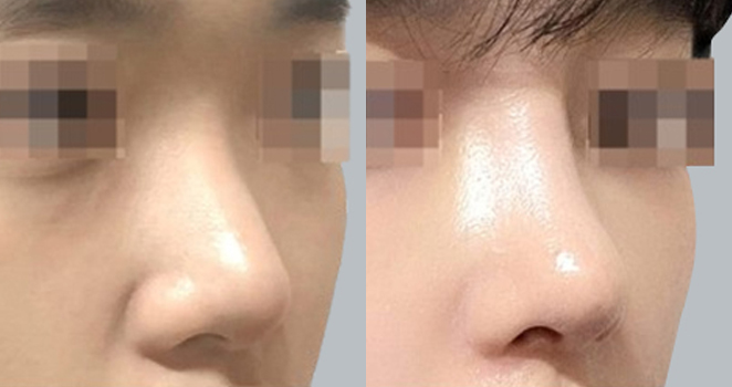 개방코성형