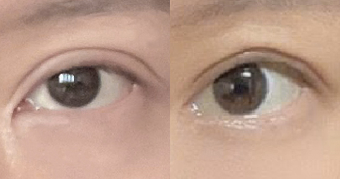 절개 눈매교정 재수술