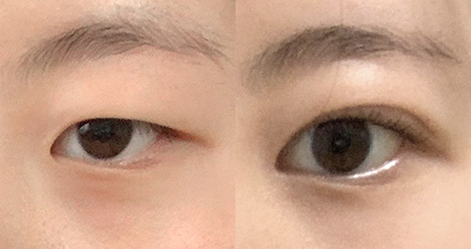 눈매교정+앞트임