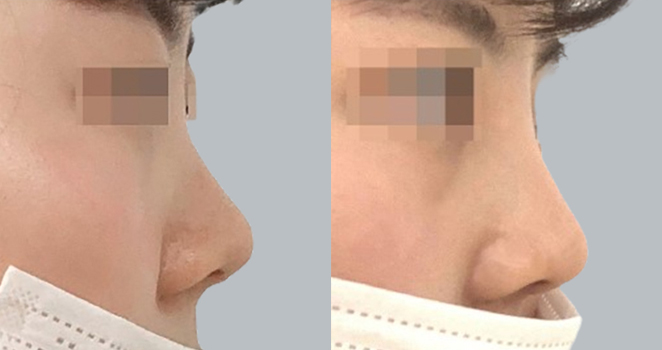 개방코성형