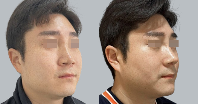 개방코성형+자가늑연골