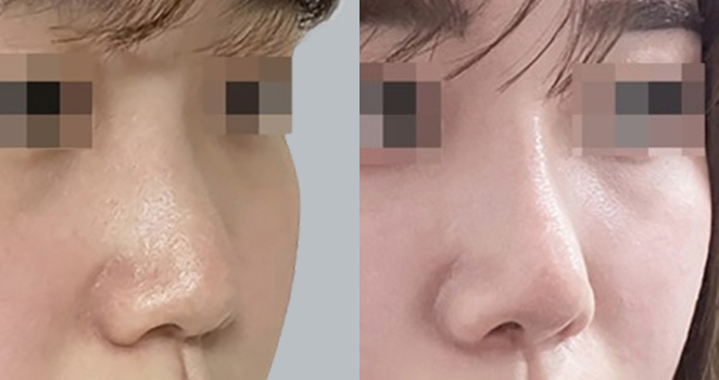 개방코성형