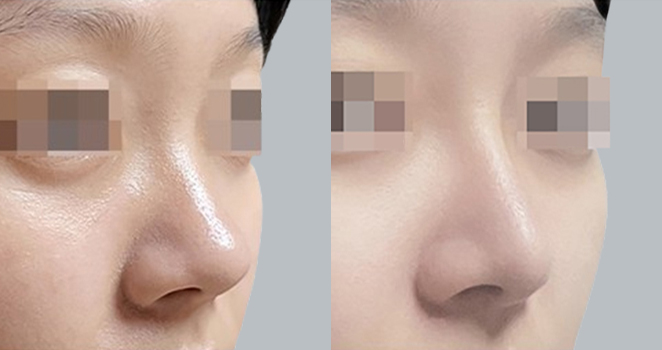 개방코성형