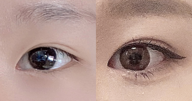 눈매교정+듀얼트임