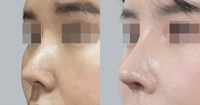 3D맞춤보형물+자가늑연골 재수술
