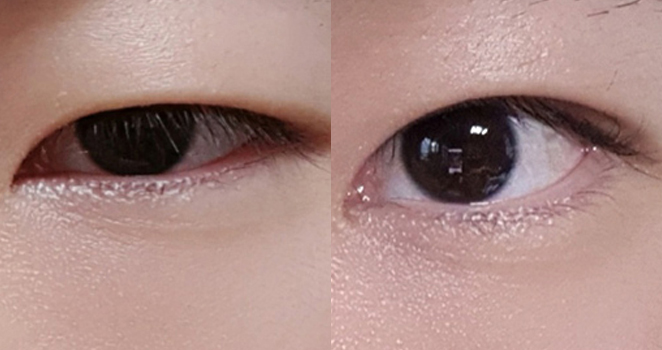 절개 눈매교정