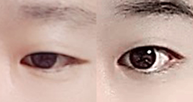 앞+위+뒤+밑트팀