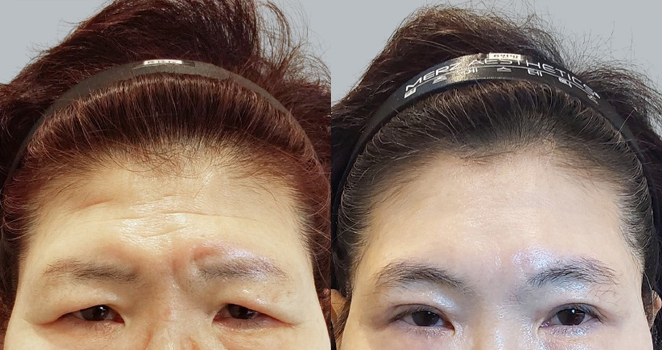 눈썹 이마거상술