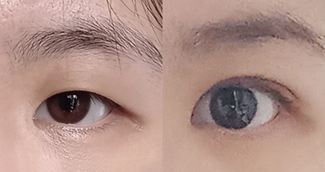 비절개 눈매교정+앞트임
