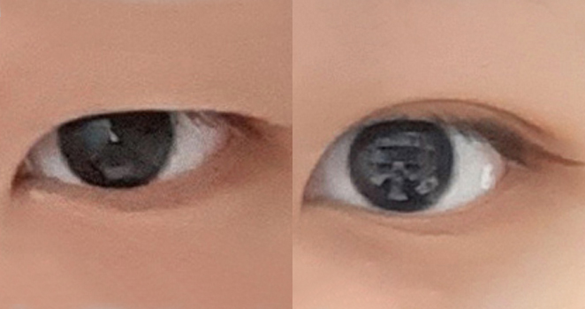 매몰 쌍꺼풀