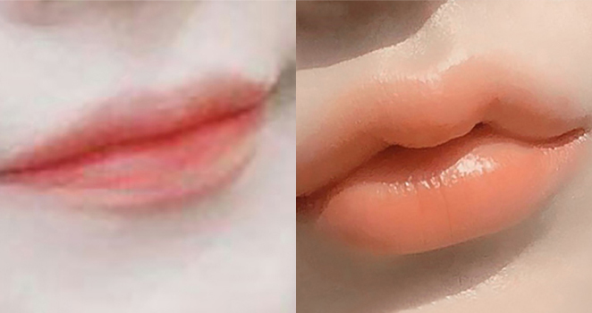 입술필러