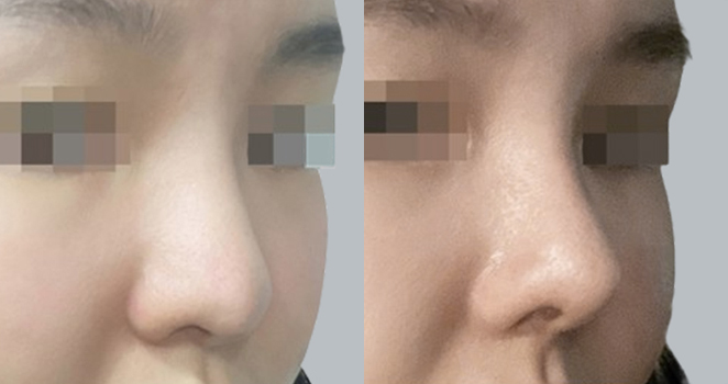 코재수술