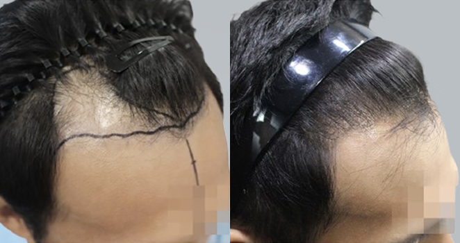 남성 모발이식 절개 2492모