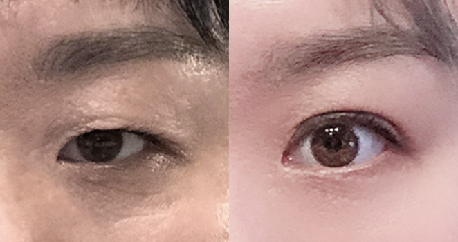 절개 눈매교정+앞트임