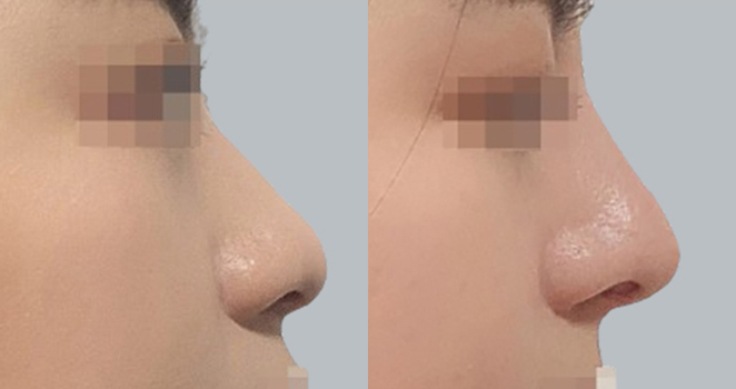 개방코성형