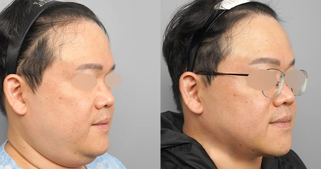 이중턱흡입+근육묶기