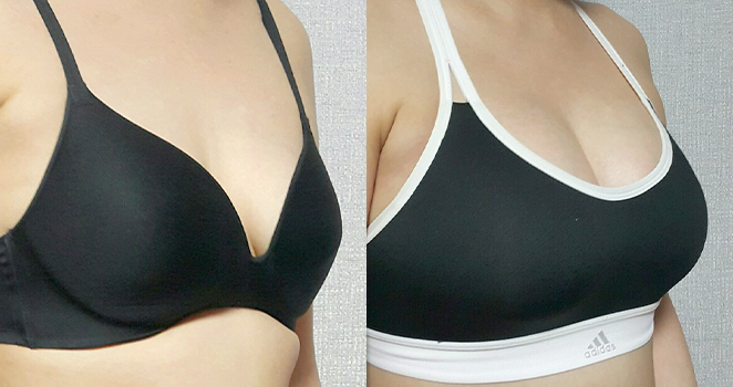 가슴확대(물방울 375cc)